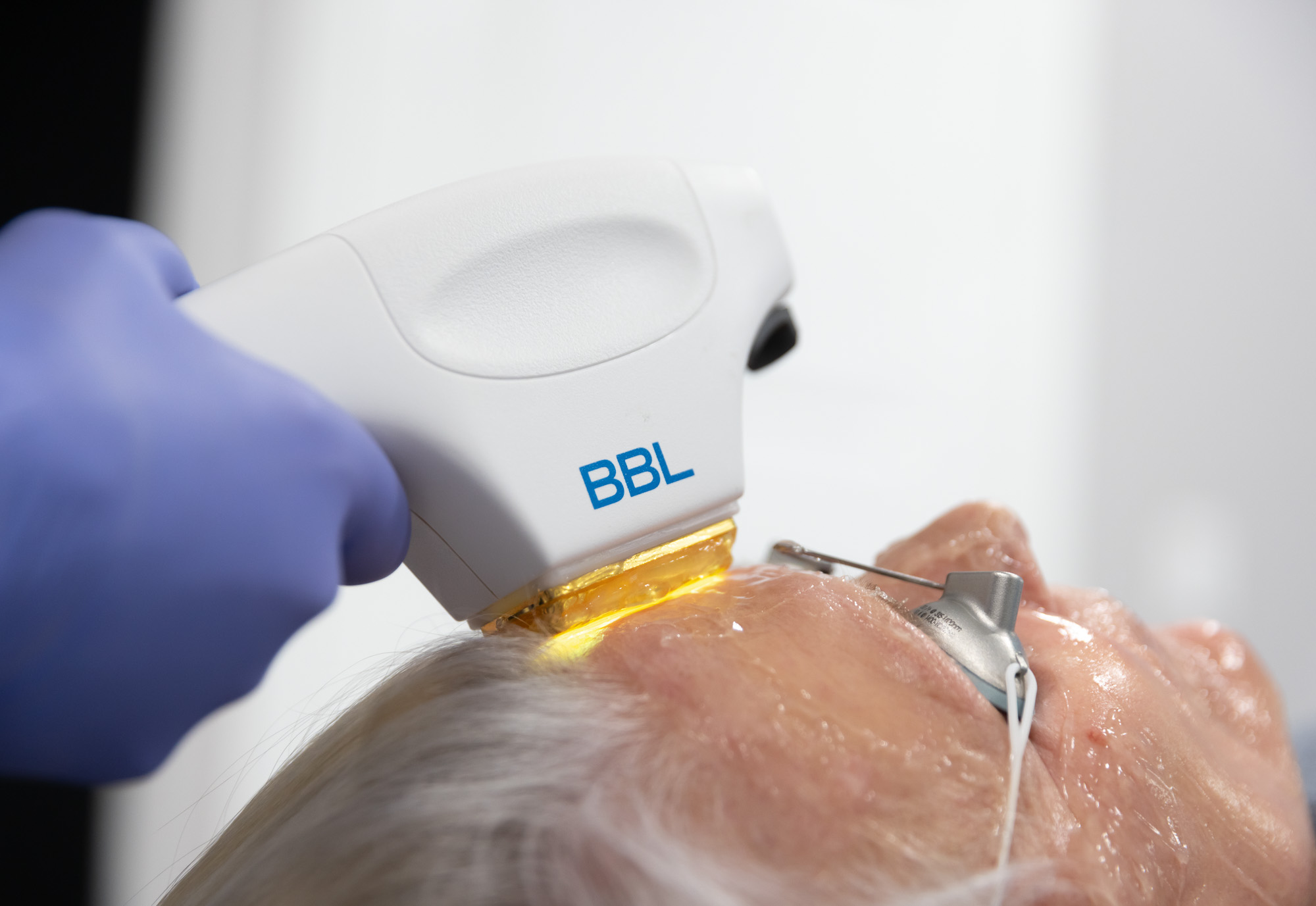 BBL Laser Treatment